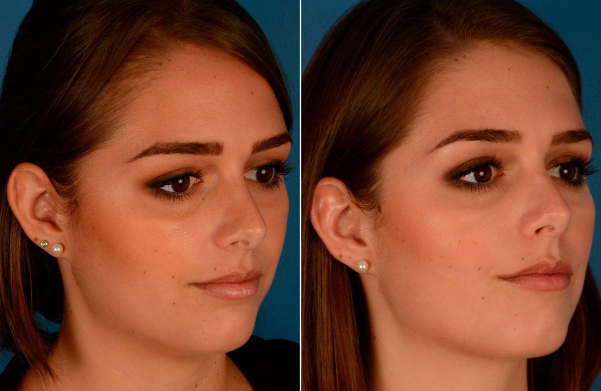 Neck Liposuction Before and After Photos in Naples, FL, Patient 13637