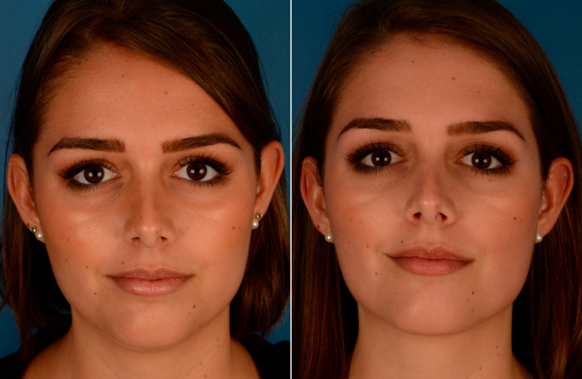 Neck Liposuction Before and After Photos in Naples, FL, Patient 13637