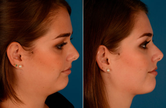 Neck Liposuction Before and After Photos in Naples, FL, Patient 13637