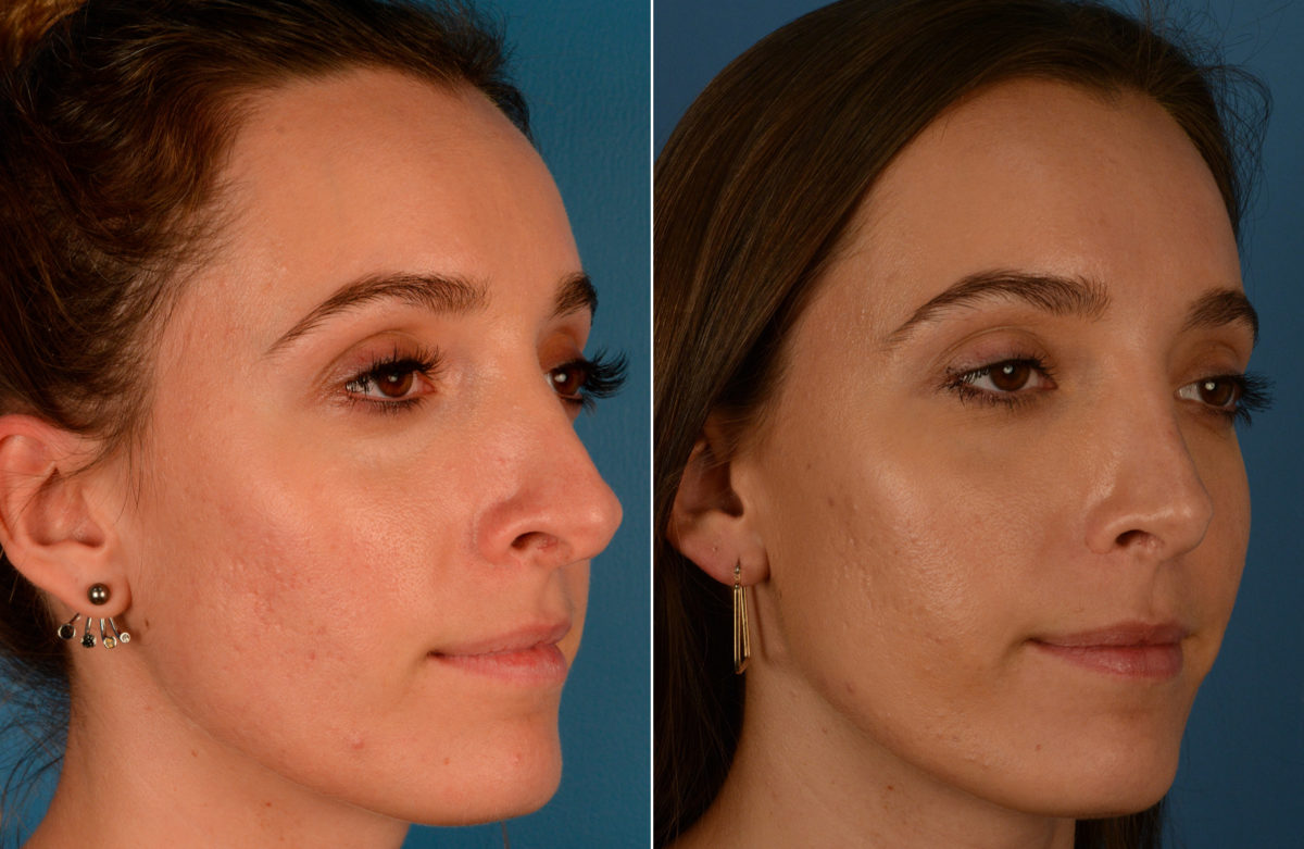 Revision Rhinoplasty Before and After Photos in Naples, FL, Patient 13736