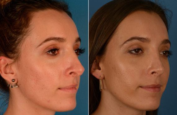 Revision Rhinoplasty Before and After Photos in Naples, FL, Patient 13736
