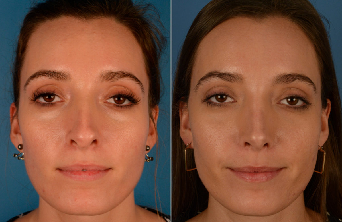 Revision Rhinoplasty Before and After Photos in Naples, FL, Patient 13736