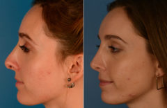 Revision Rhinoplasty Before and After Photos in Naples, FL, Patient 13736