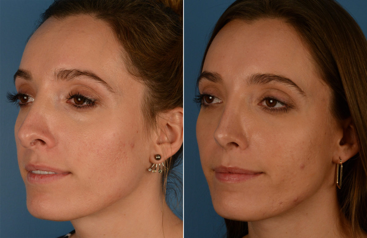 Revision Rhinoplasty Before and After Photos in Naples, FL, Patient 13736