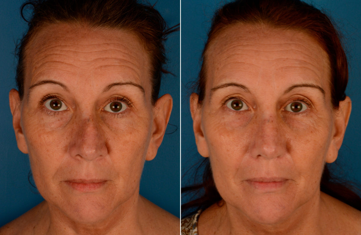 Revision Rhinoplasty Before and After Photos in Naples, FL, Patient 13746