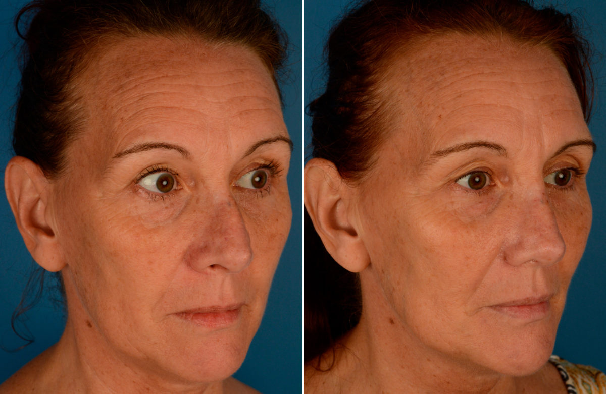 Revision Rhinoplasty Before and After Photos in Naples, FL, Patient 13746