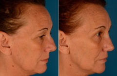 Revision Rhinoplasty Before and After Photos in Naples, FL, Patient 13746