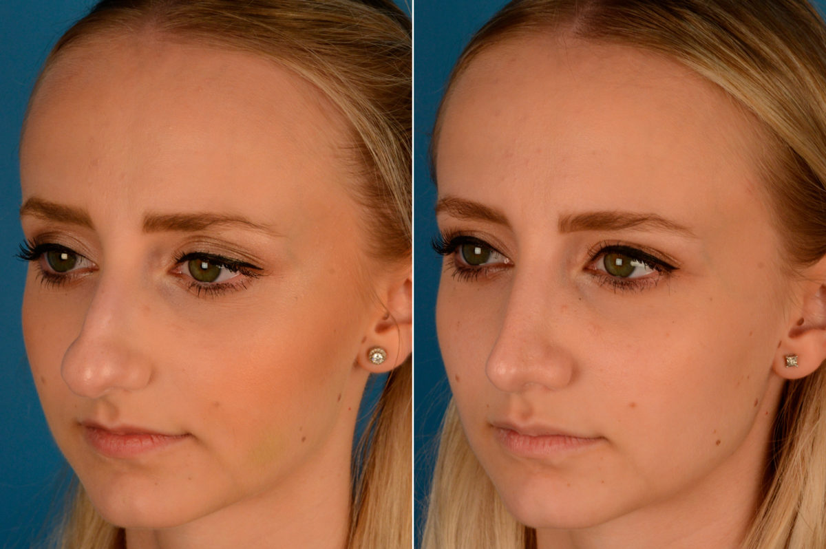 Rhinoplasty Before and After Photos in Naples, FL, Patient 13809