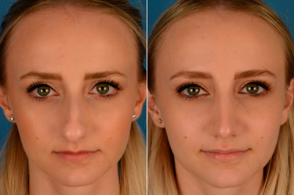 Rhinoplasty Before and After Photos in Naples, FL, Patient 13809