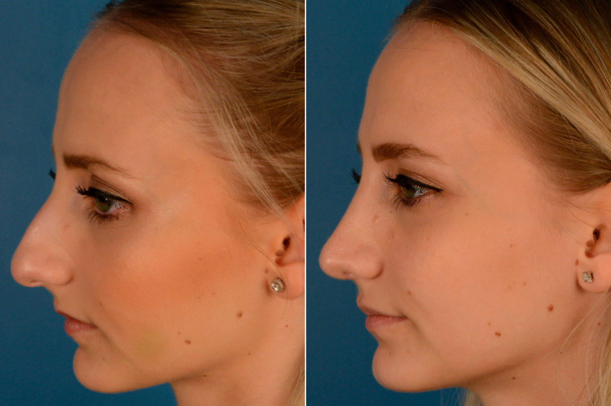 Rhinoplasty Before and After Photos in Naples, FL, Patient 13809