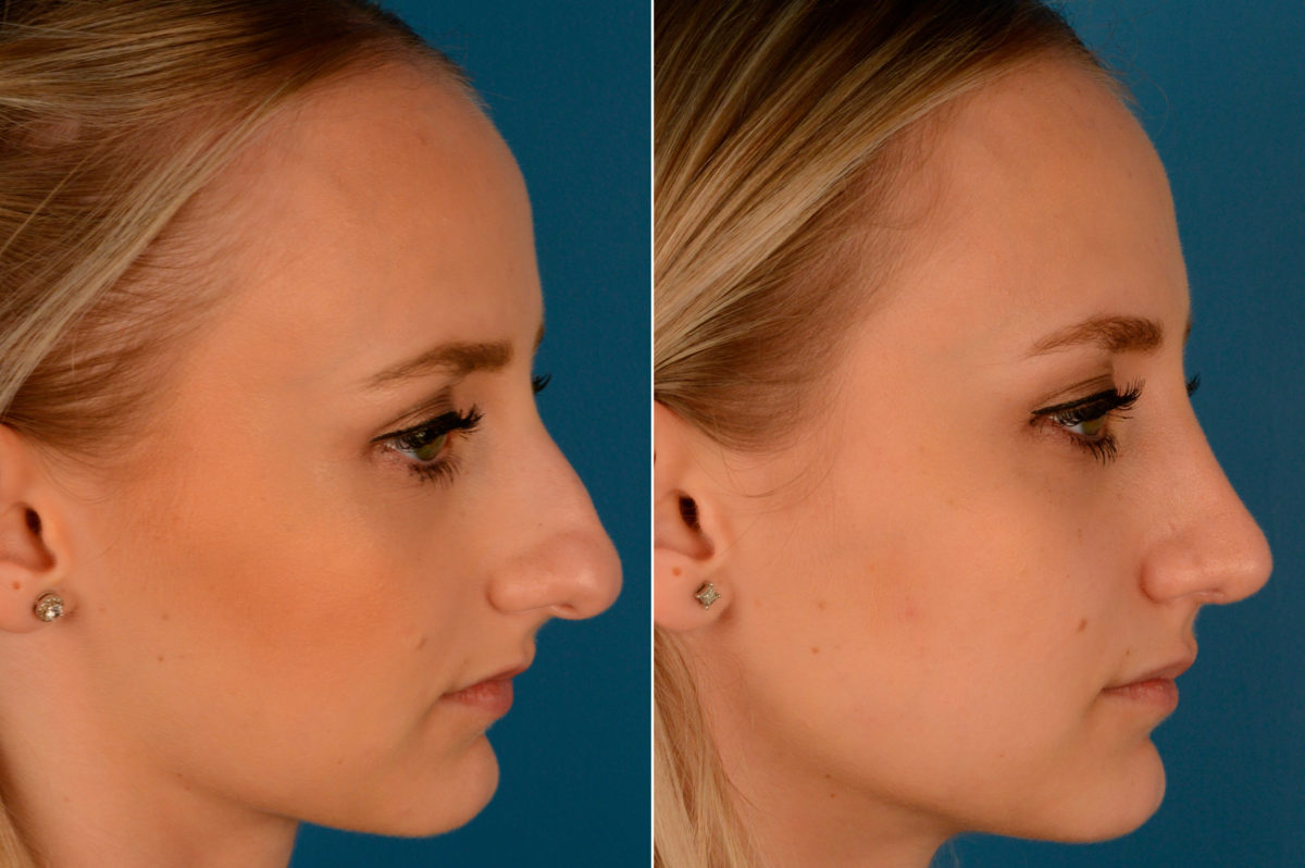 Rhinoplasty Before and After Photos in Naples, FL, Patient 13809