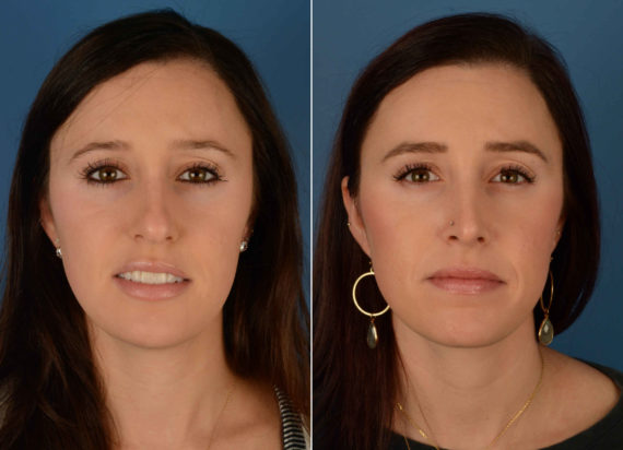 Rhinoplasty Before and After Photos in Naples, FL, Patient 13887