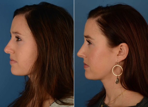 Rhinoplasty Before and After Photos in Naples, FL, Patient 13887