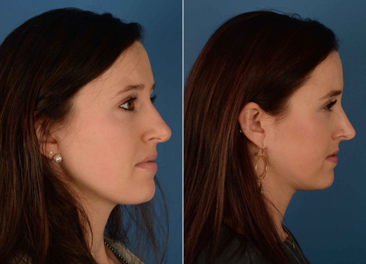 Rhinoplasty Before and After Photos in Naples, FL, Patient 13887