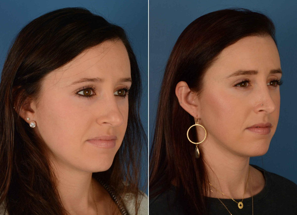 Rhinoplasty Before and After Photos in Naples, FL, Patient 13887