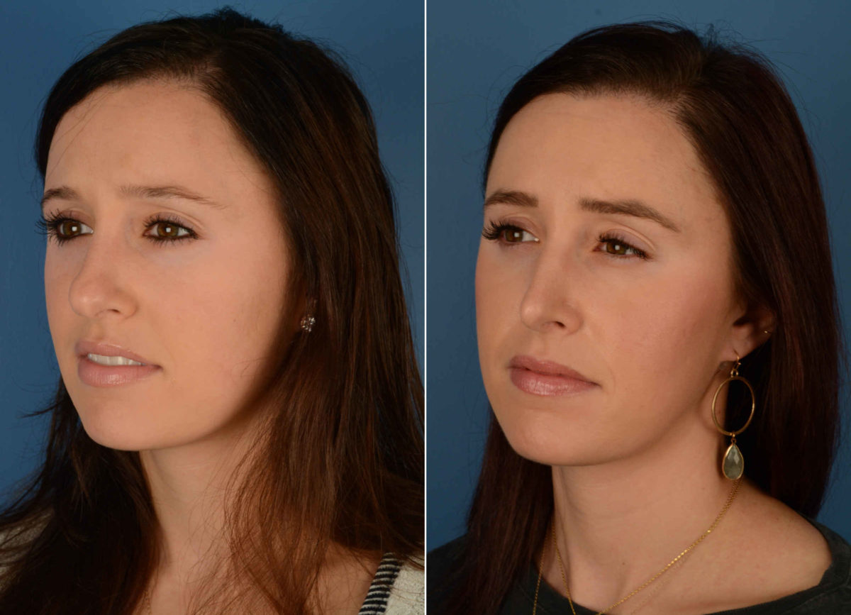 Rhinoplasty Before and After Photos in Naples, FL, Patient 13887