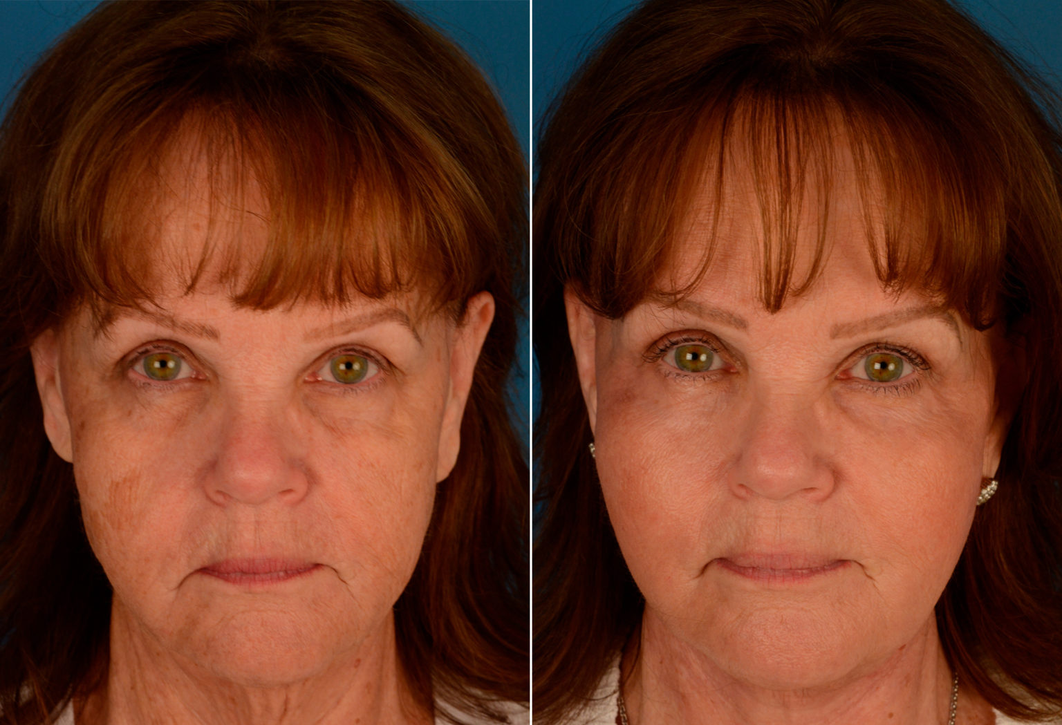 Endoscopic Facelift Photos Naples, FL Patient 13933