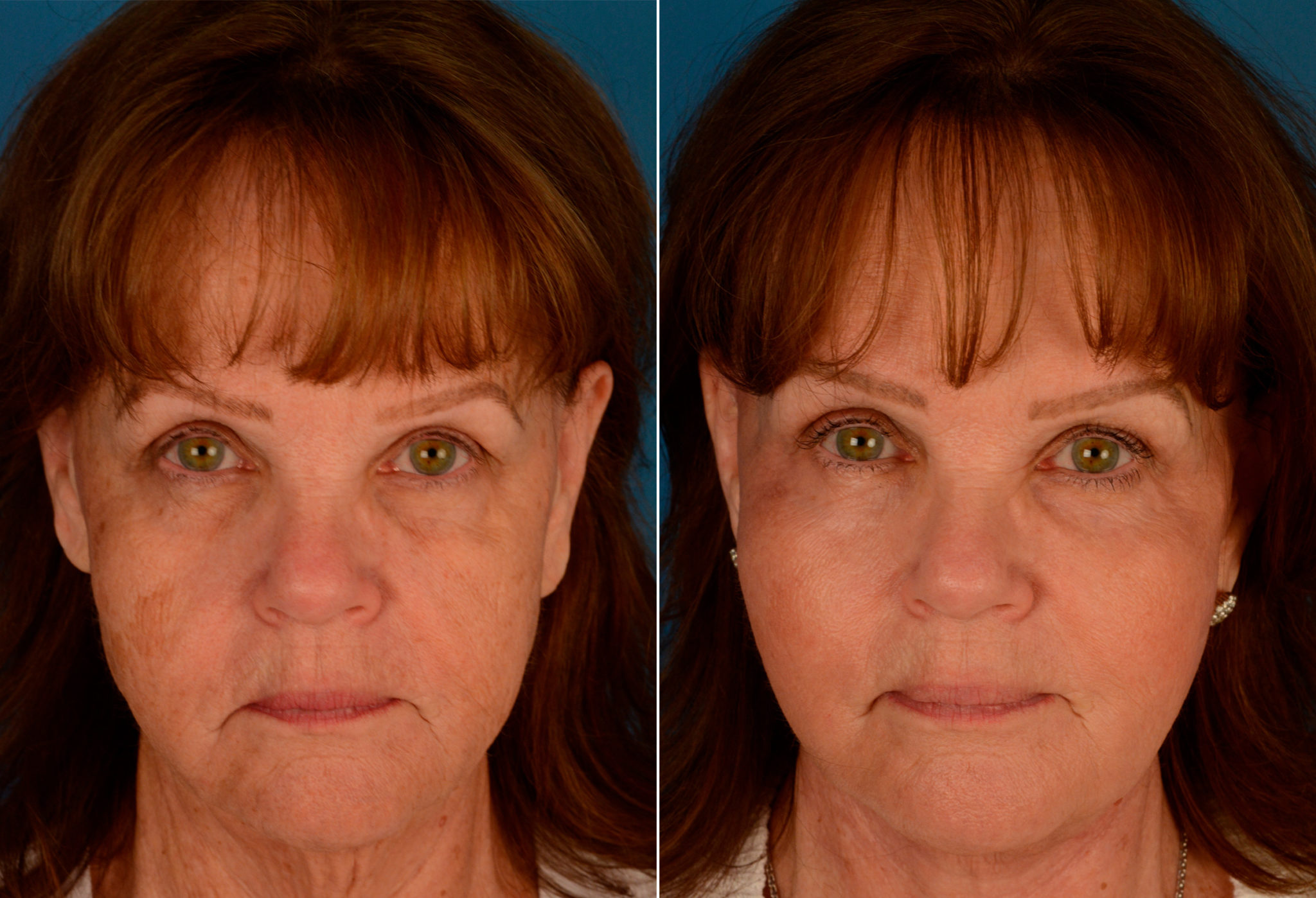 Endoscopic Facelift Photos Naples, FL Patient 13933