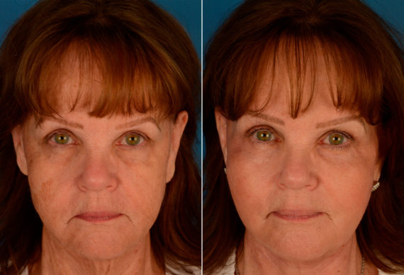 Endoscopic Facelift Before and After Photos in Naples, FL, Patient 13933