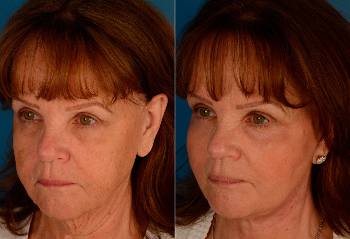 Endoscopic Facelift Before and After Photos in Naples, FL, Patient 13933