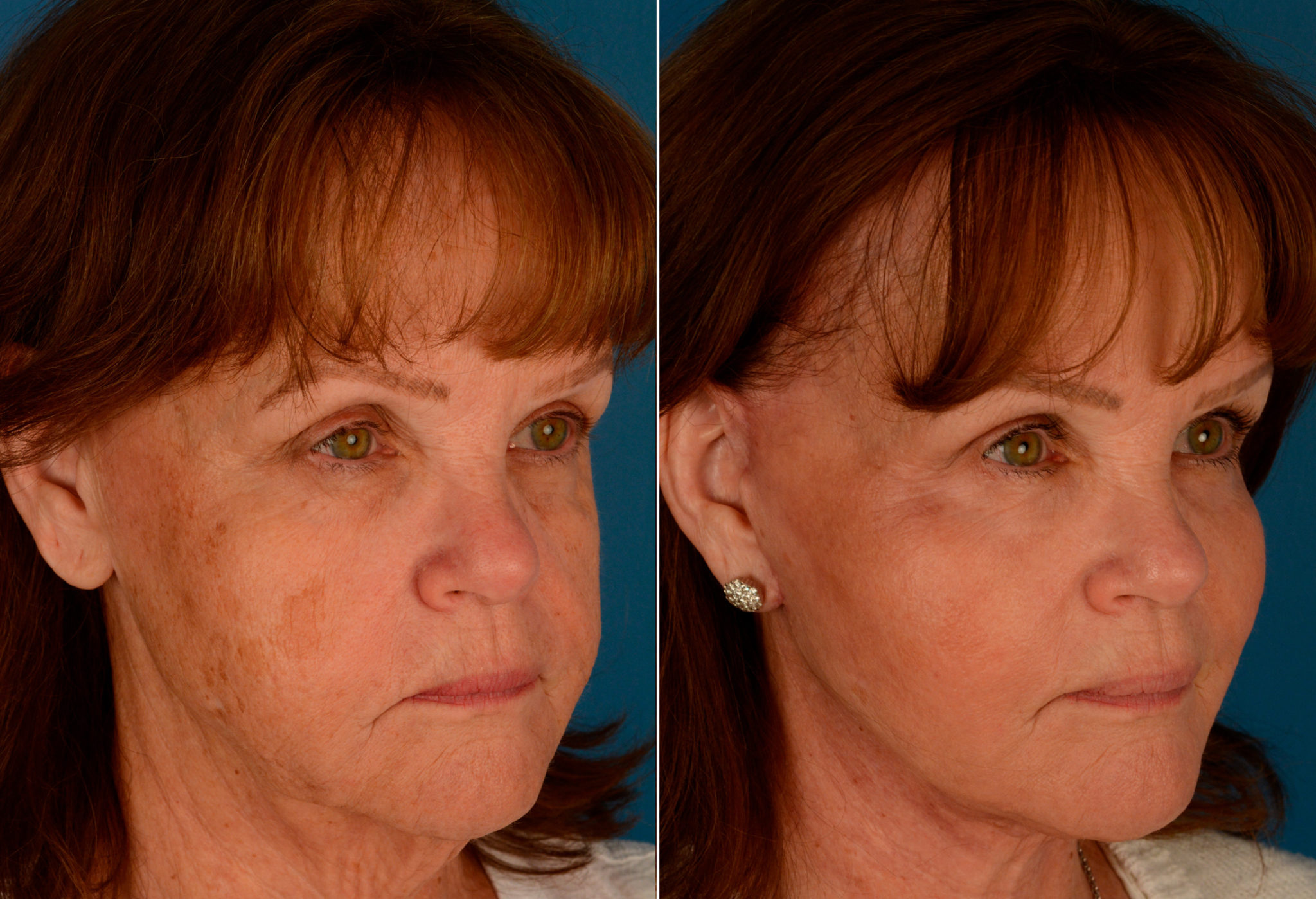 Endoscopic Facelift Photos Naples, FL Patient 13933