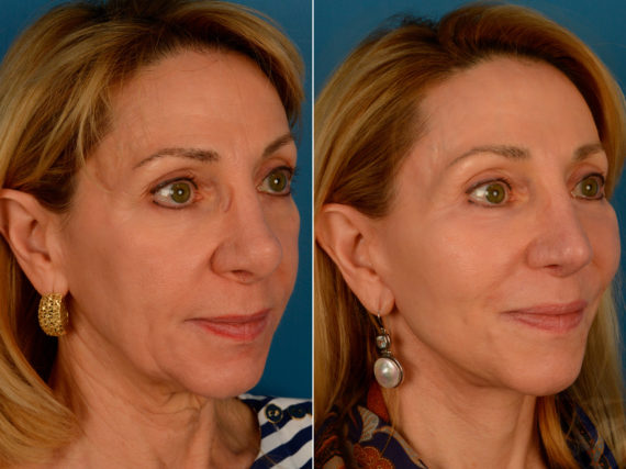 Endoscopic Facelift Before and After Photos in Naples, FL, Patient 13961