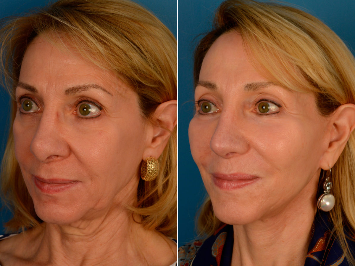 Endoscopic Facelift Before and After Photos in Naples, FL, Patient 13961