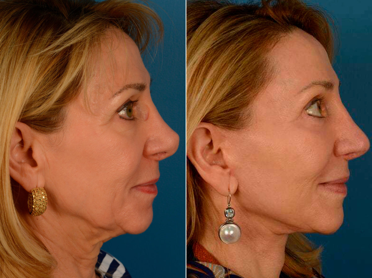Endoscopic Facelift Before and After Photos in Naples, FL, Patient 13961