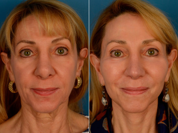 Endoscopic Facelift Before and After Photos in Naples, FL, Patient 13961