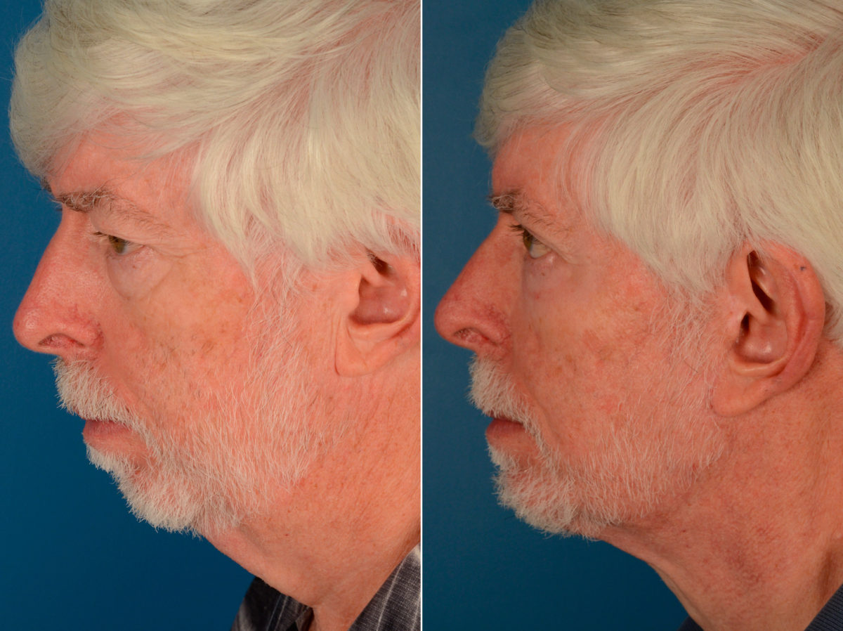 Blepharoplasty Before and After Photos in Naples, FL, Patient 13971