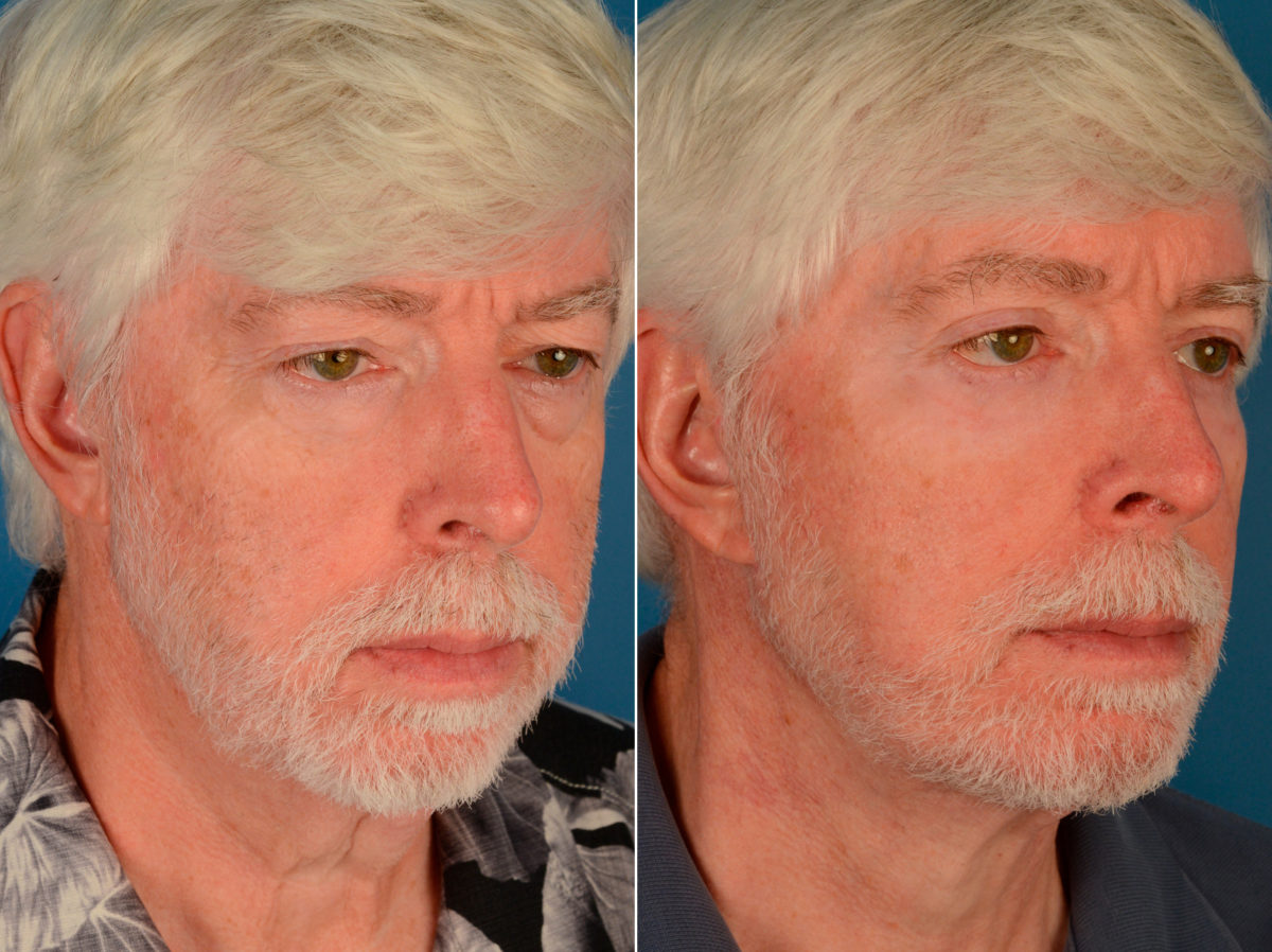 Blepharoplasty Before and After Photos in Naples, FL, Patient 13971