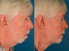 Blepharoplasty Before and After Photos in Naples, FL, Patient 13971