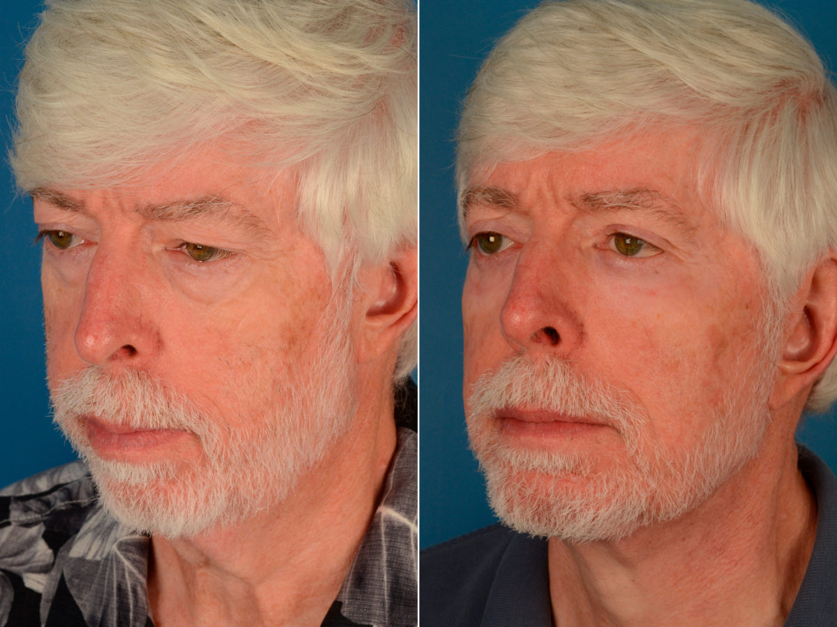 Blepharoplasty Before and After Photos in Naples, FL, Patient 13971