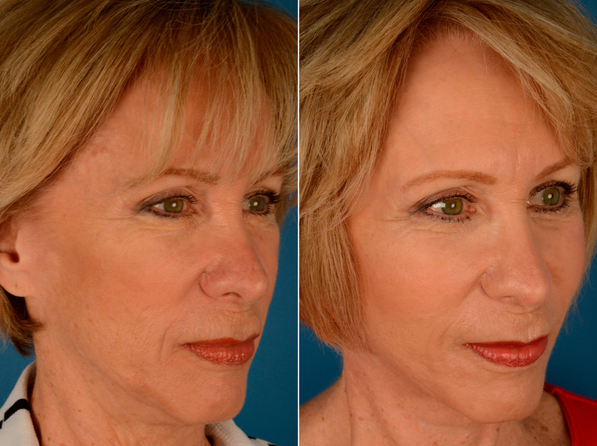 Cheek Implants Before and After Photos in Naples, FL, Patient 14016