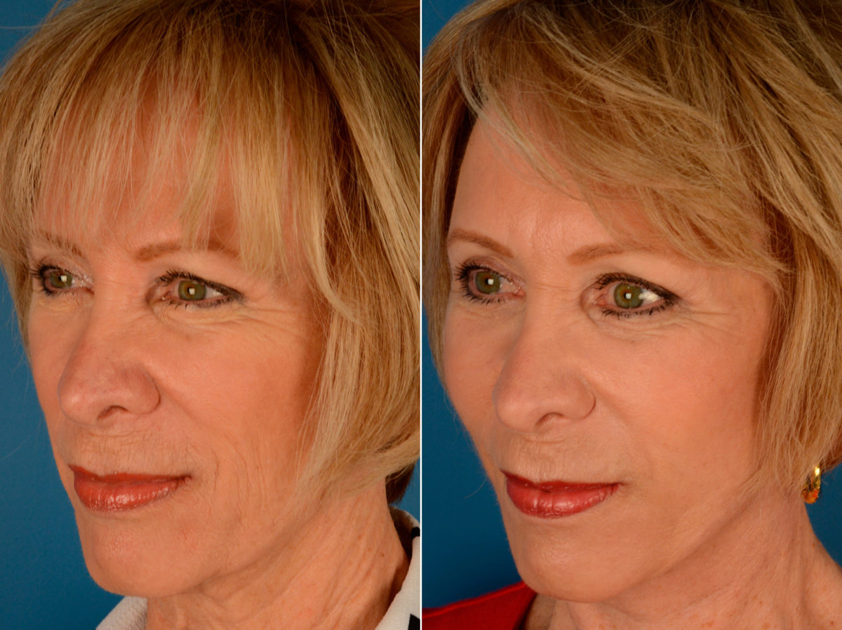 Cheek Implants Before and After Photos in Naples, FL, Patient 14016