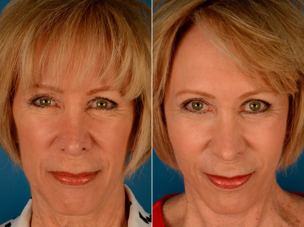 Cheek Implants Before and After Photos in Naples, FL, Patient 14016