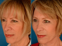 Cheek Implants Before and After Photos in Naples, FL, Patient 14016