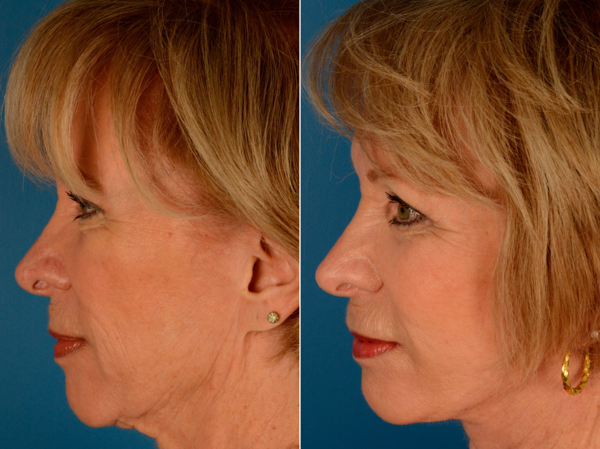Cheek Implants Before and After Photos in Naples, FL, Patient 14016