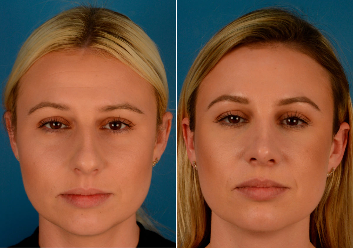 Rhinoplasty Before and After Photos in Naples, FL, Patient 14133