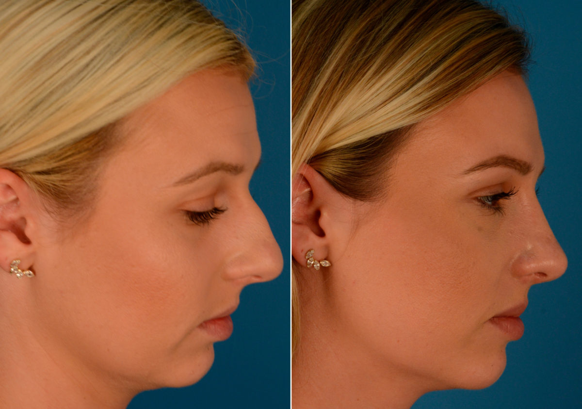 Rhinoplasty Before and After Photos in Naples, FL, Patient 14133