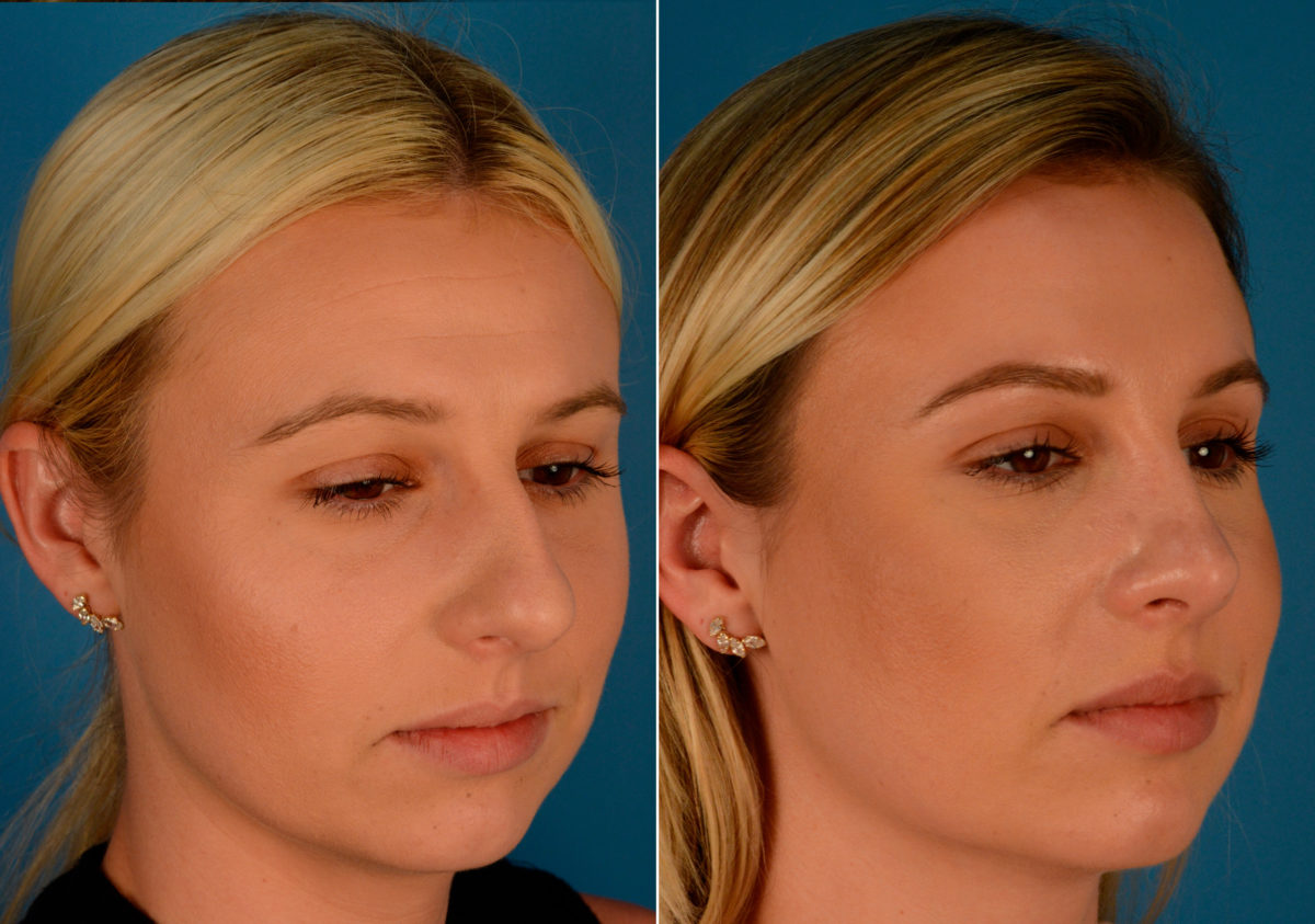 Rhinoplasty Before and After Photos in Naples, FL, Patient 14133