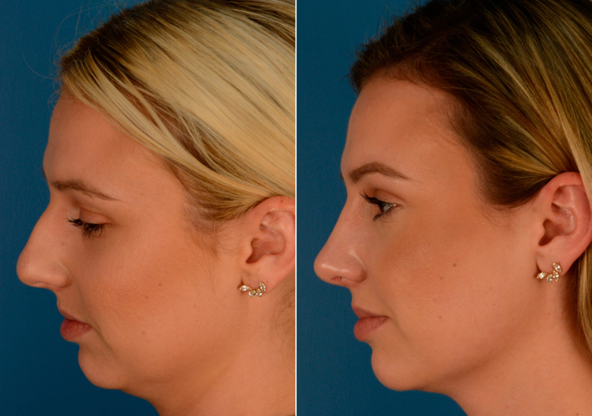 Rhinoplasty Before and After Photos in Naples, FL, Patient 14133