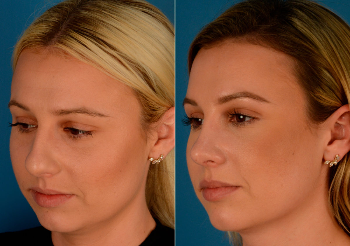 Rhinoplasty Before and After Photos in Naples, FL, Patient 14133