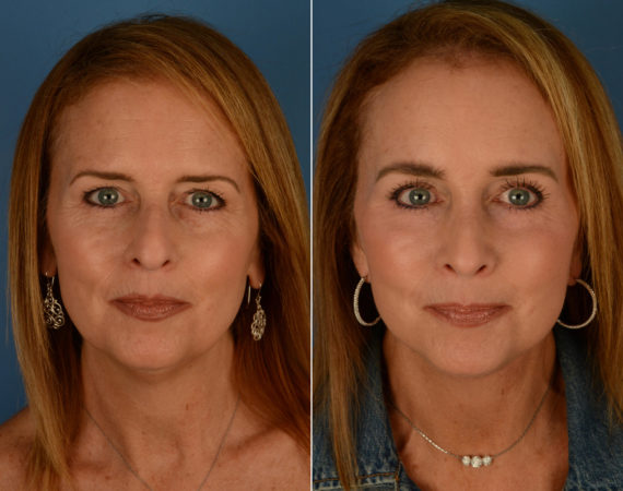 Eyebrow & Forehead Before and After Photos in Naples, FL, Patient 14205