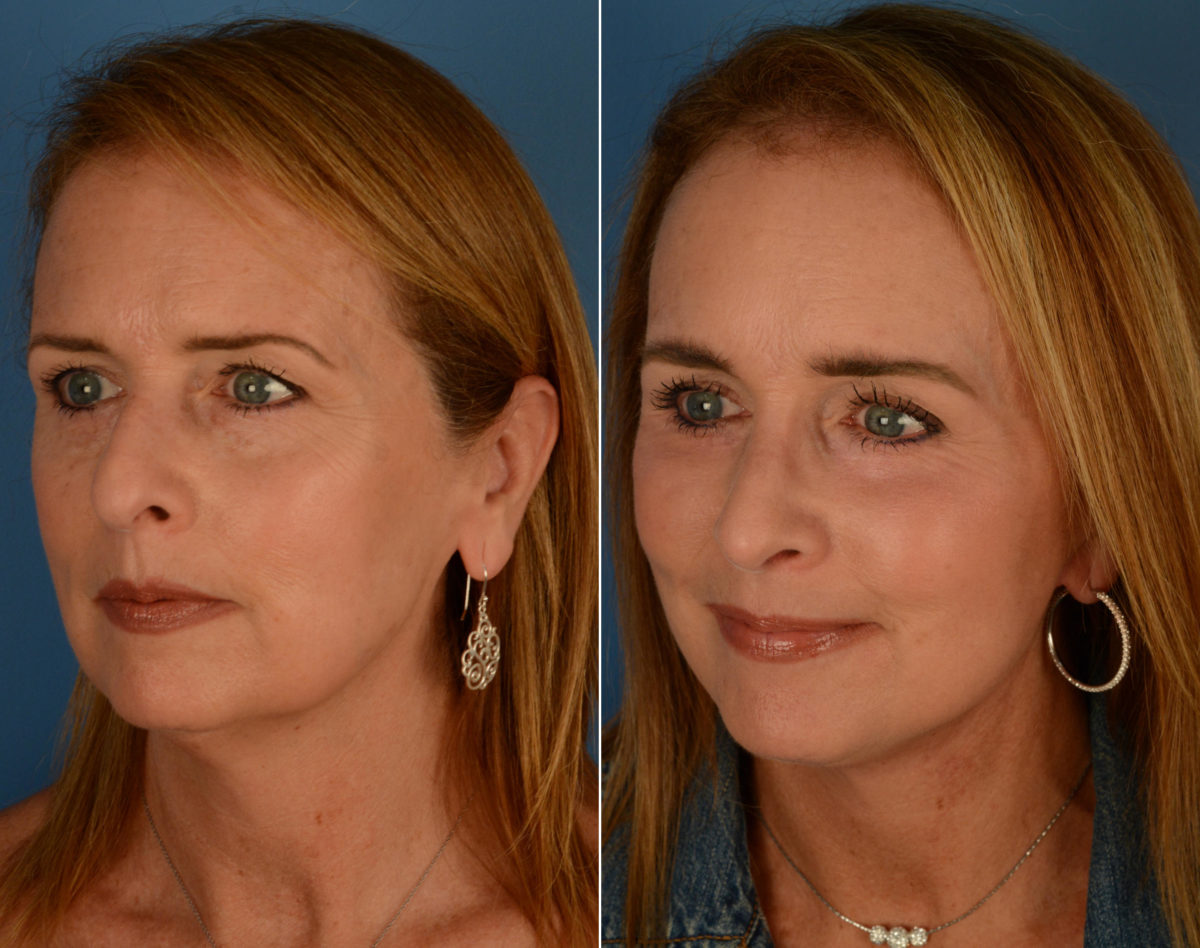Eyebrow & Forehead Before and After Photos in Naples, FL, Patient 14205