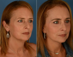 Eyebrow & Forehead Before and After Photos in Naples, FL, Patient 14205