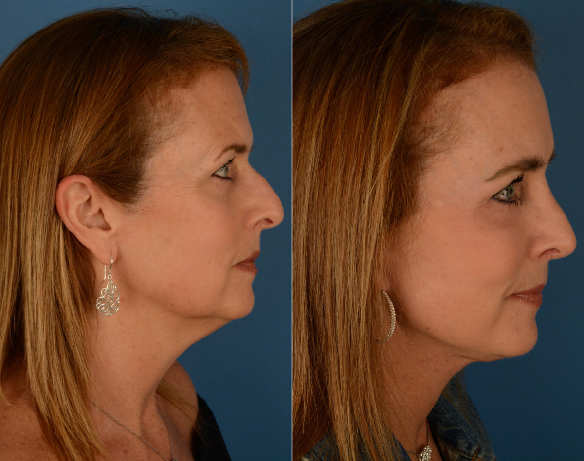 Eyebrow & Forehead Before and After Photos in Naples, FL, Patient 14205