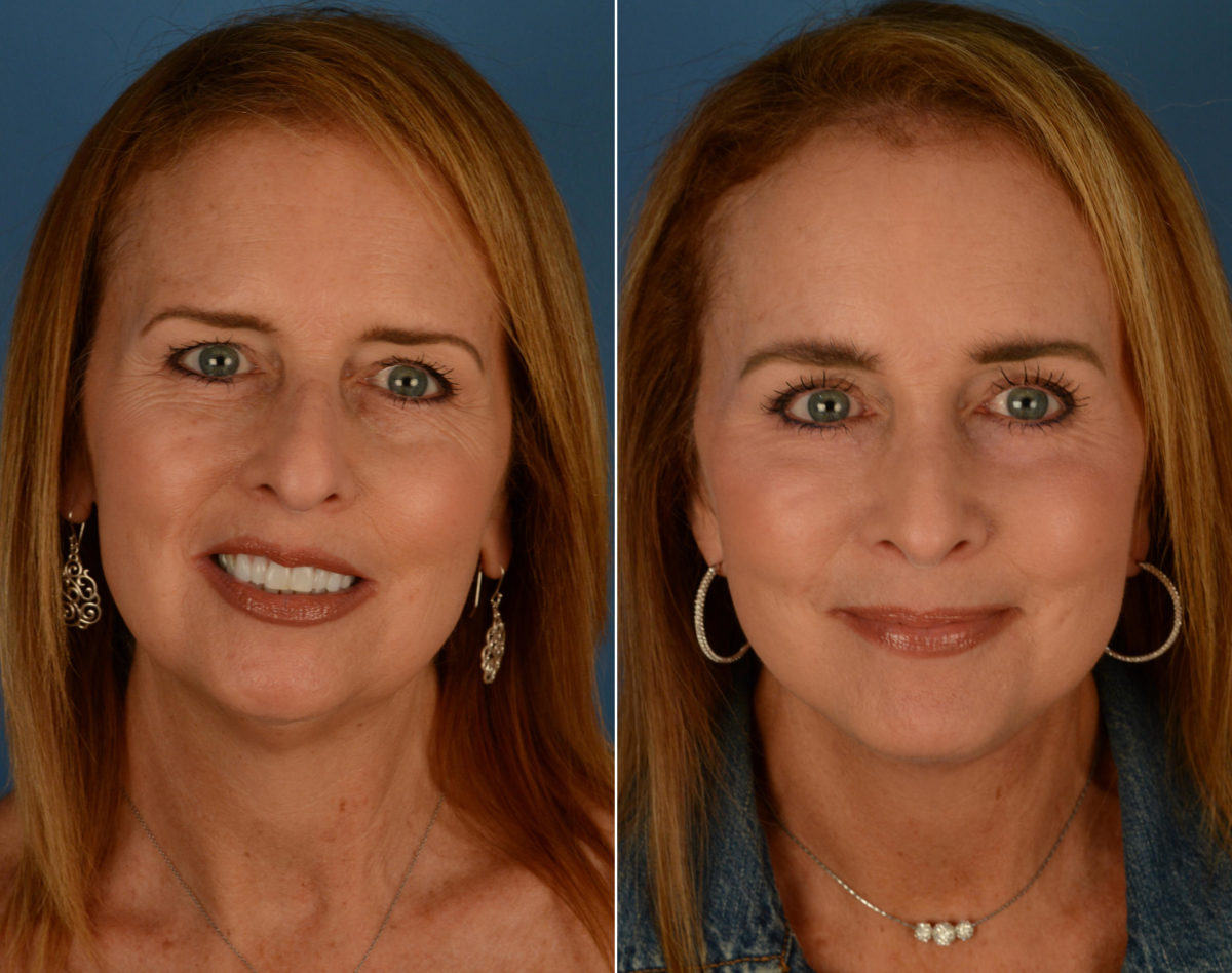Eyebrow & Forehead Before and After Photos in Naples, FL, Patient 14205