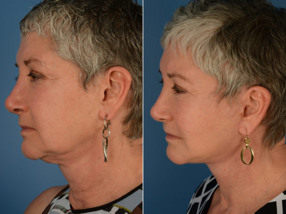 Endoscopic Facelift Before and After Photos in Naples, FL, Patient 14226