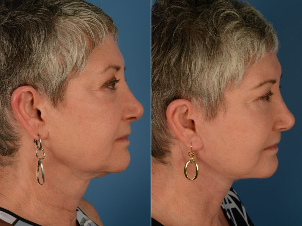 Endoscopic Facelift Photos Naples, FL Patient 14226